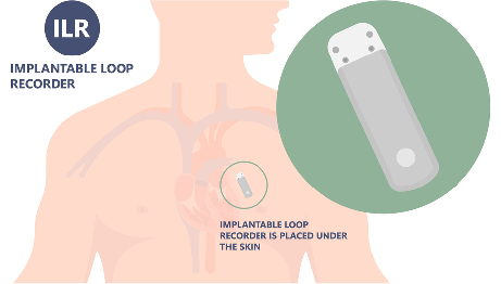 Diagram showing where an implantable loop recorder sits under the skin of the chest