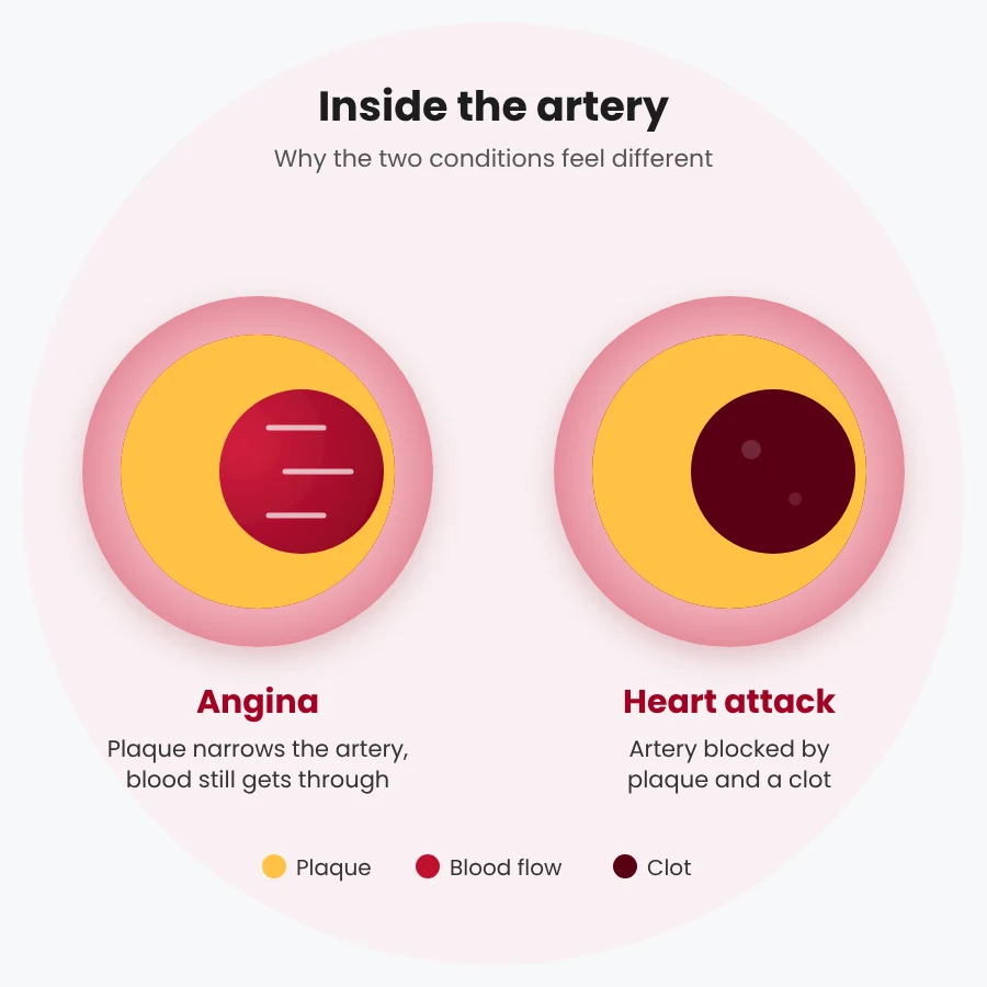 Artery cross-sections: plaque narrows the artery in angina, while plaque and a clot block it in a heart attack