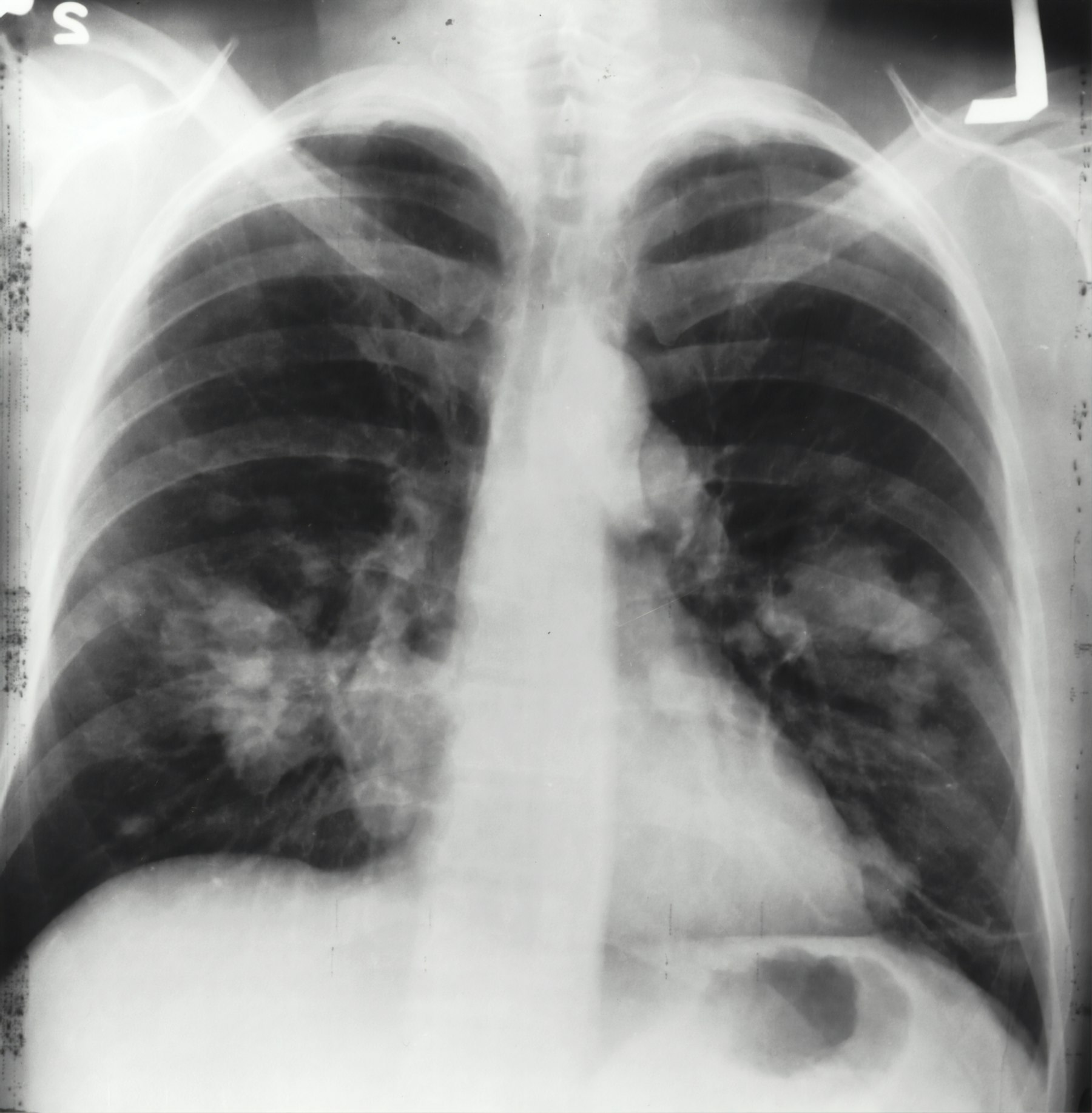 Chest X-ray of the lungs used in pulmonary embolism care