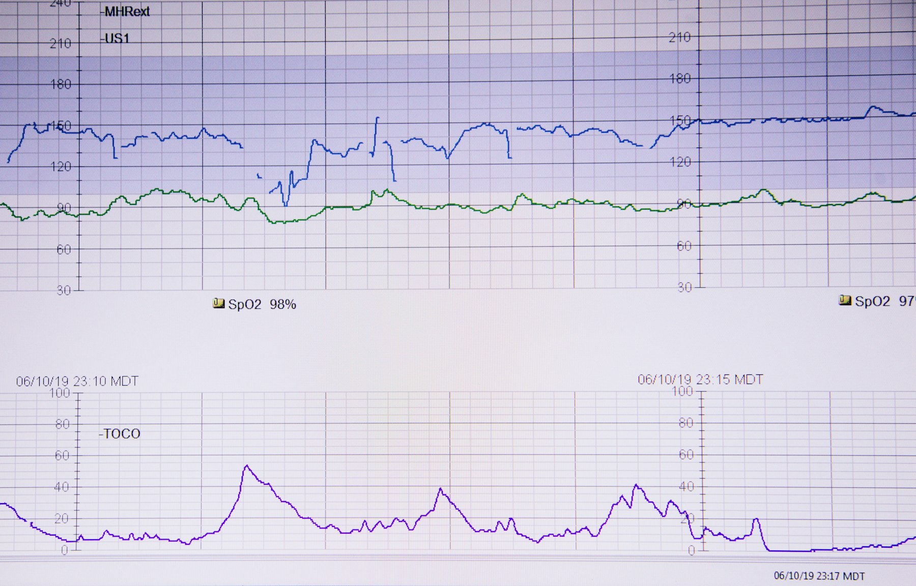 ECG strip showing an irregular heart rhythm