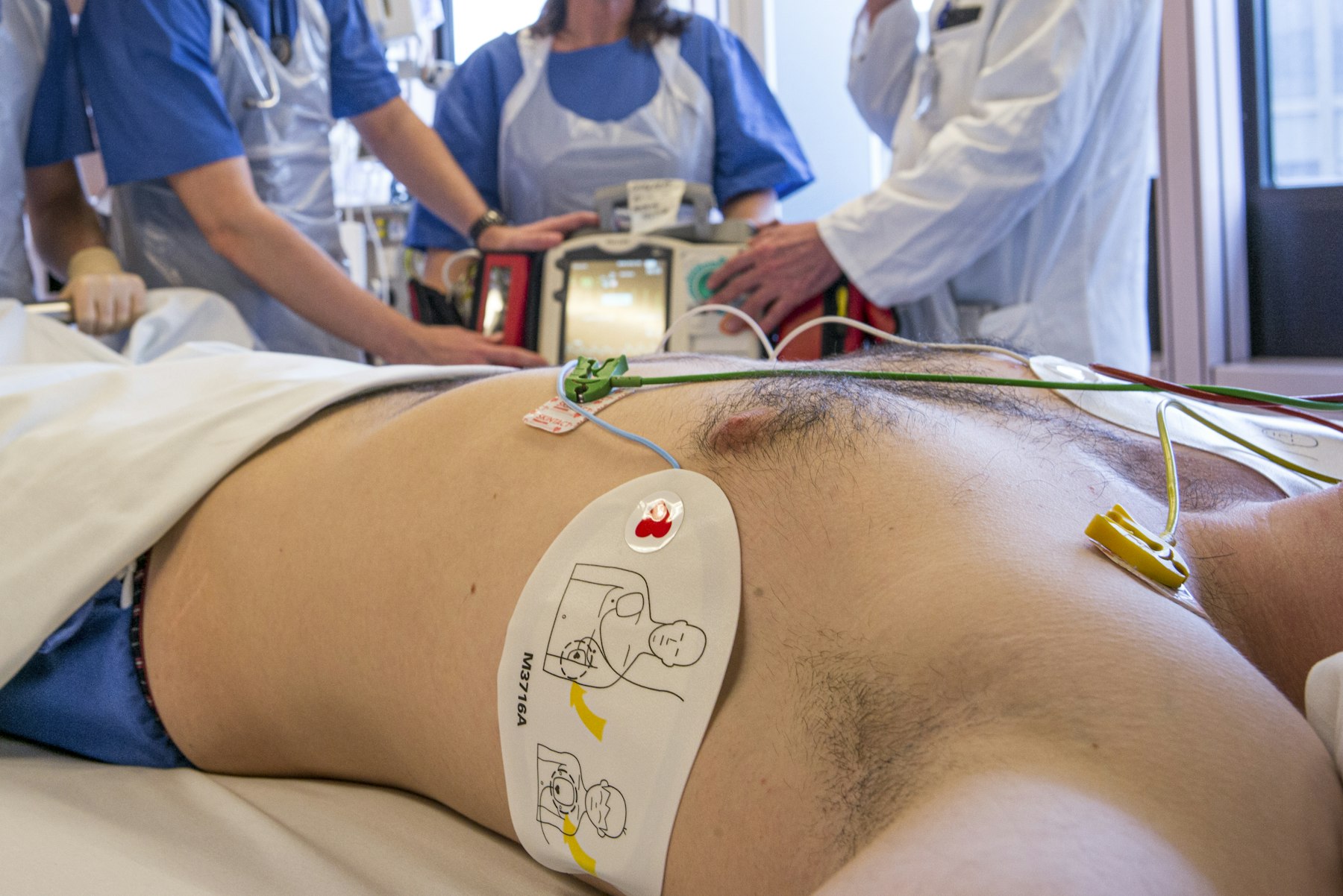 Electrode pads placed on a patient’s chest for cardioversion